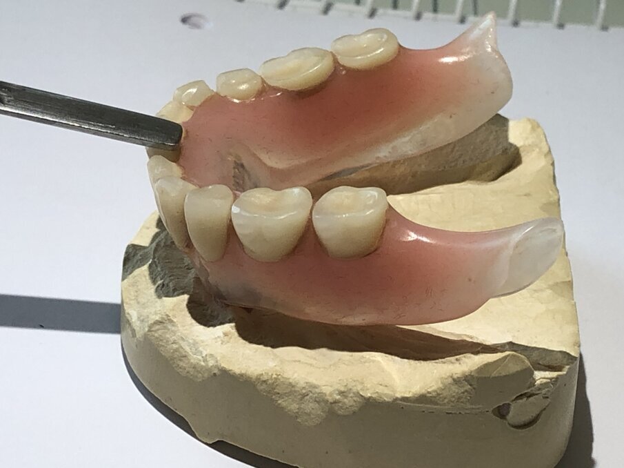 Afbeelding 7. Bij het kauwen komt de dorsale zijde van de prothese omhoog.  