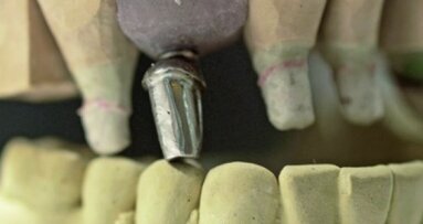 Abutment fracture in a bridge supported by natural teeth and implants