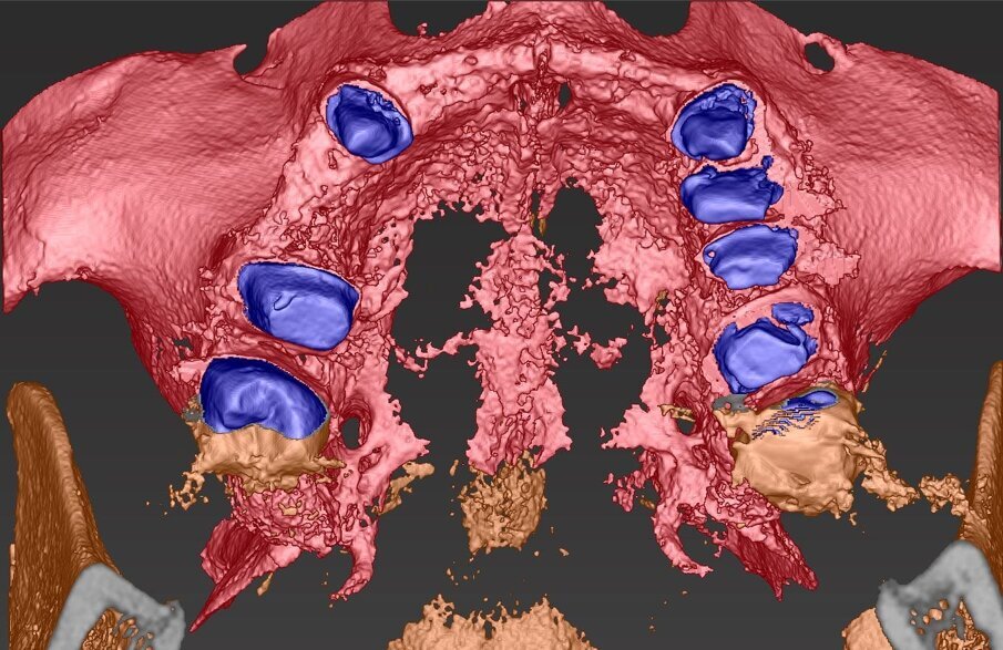 Fig. 9_Nel taglio sagittale è possibile verificare la porzione ossea presente sull’intera arcata, si notano le preparazioni degli elementi naturali che faranno da link per la connessione nel progetto elaborato.