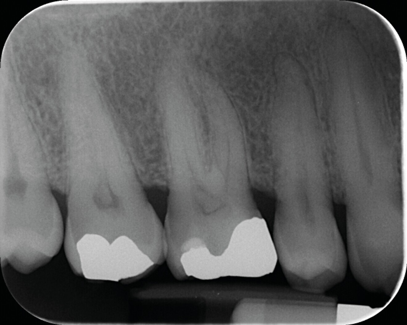 Fig. 6b : Radiographie postopératoire du traitement canalaire – mise en forme avec le système BlueShaper (Zarc – Endoboutik), désinfection avec hypochlorite de sodium activé avec Irriflex (Produits Dentaires) et obturation en compaction verticale de gutta chaude.