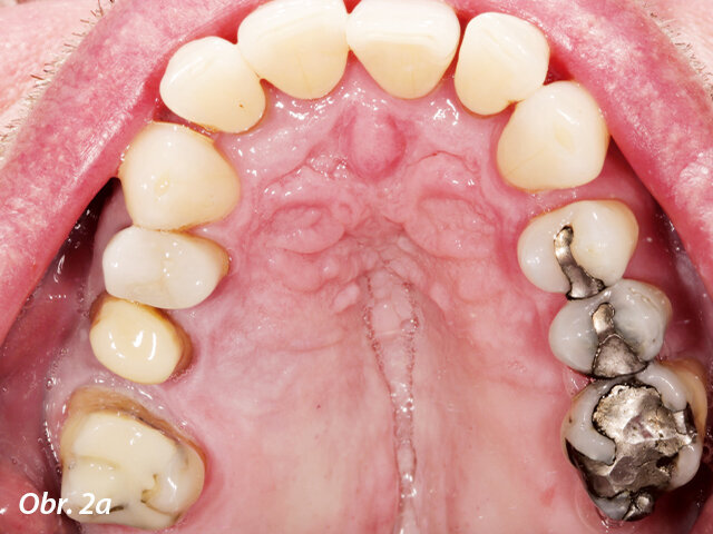 Pacient požadoval výměnu amalgámových výplní v horní (a) a dolní (b) čelisti za celokeramické náhrady.