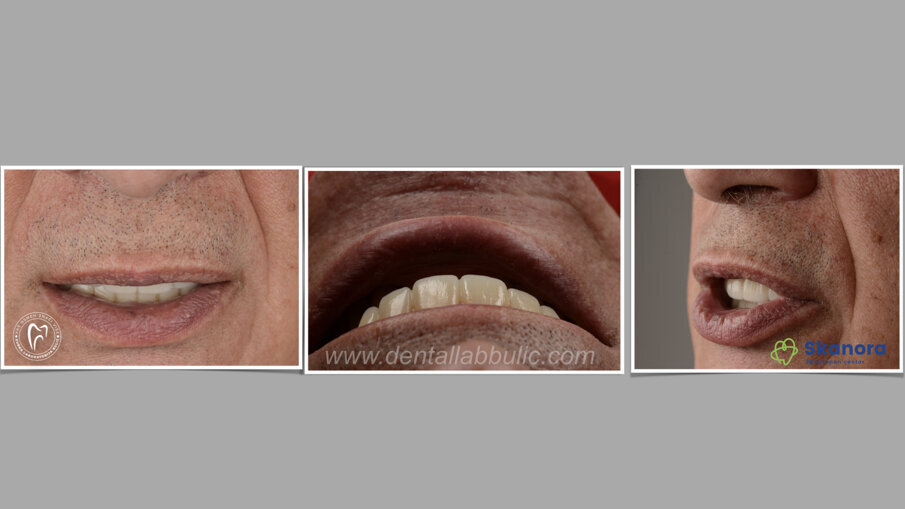 Slika 6-003 izgled definitivnog rada u ustima 