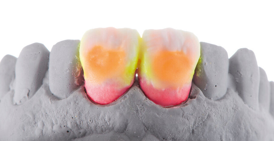 Fig. 7 & 8: Alternating the layers with the materials chosen during shade determination