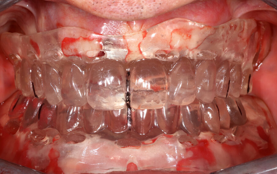 Fig. 4_Mascherine protesiche in posizione per il controllo dell’occlusione e della ceratura diagnostica eseguita.