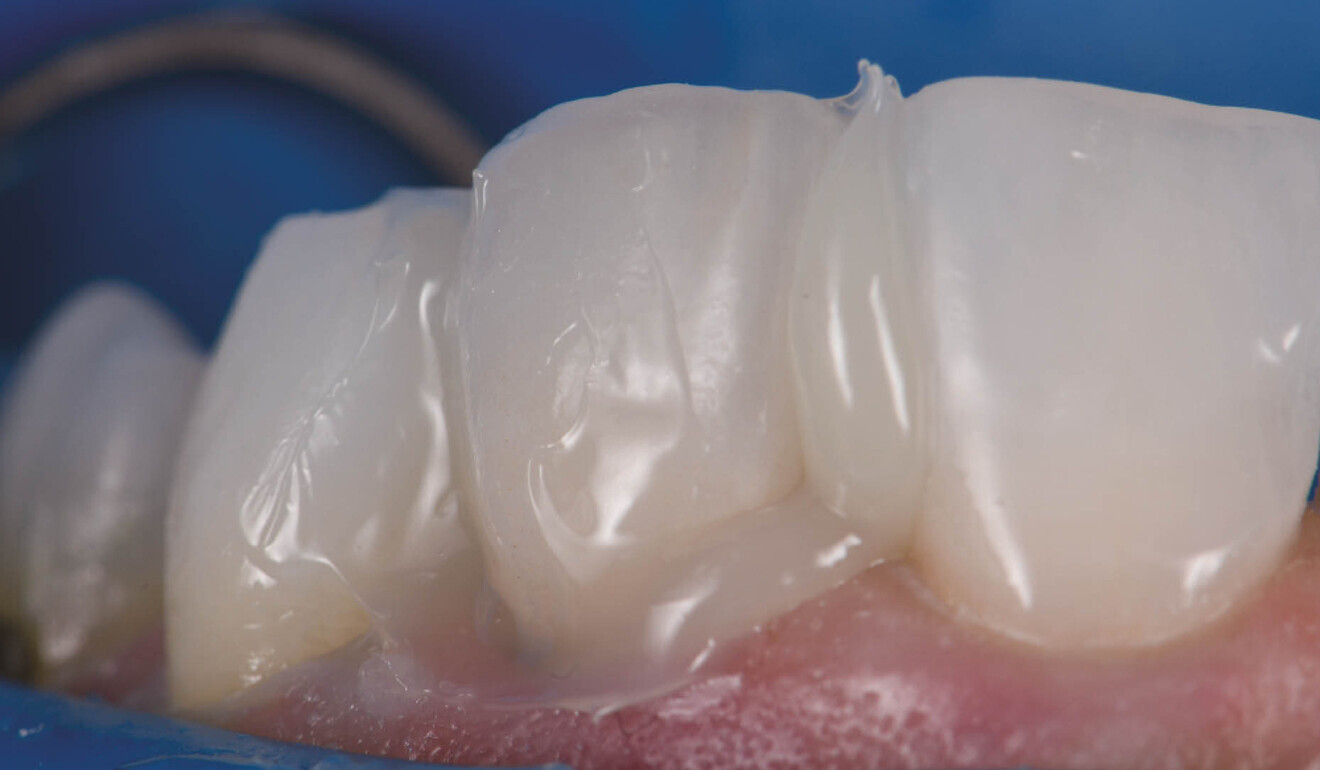 Fig. 6: PANAVIA Veneer LC immediately after seating. Note the viscous, non-slumpy nature of the cement, which allows for ease of removal under both wet and gel-phase options.