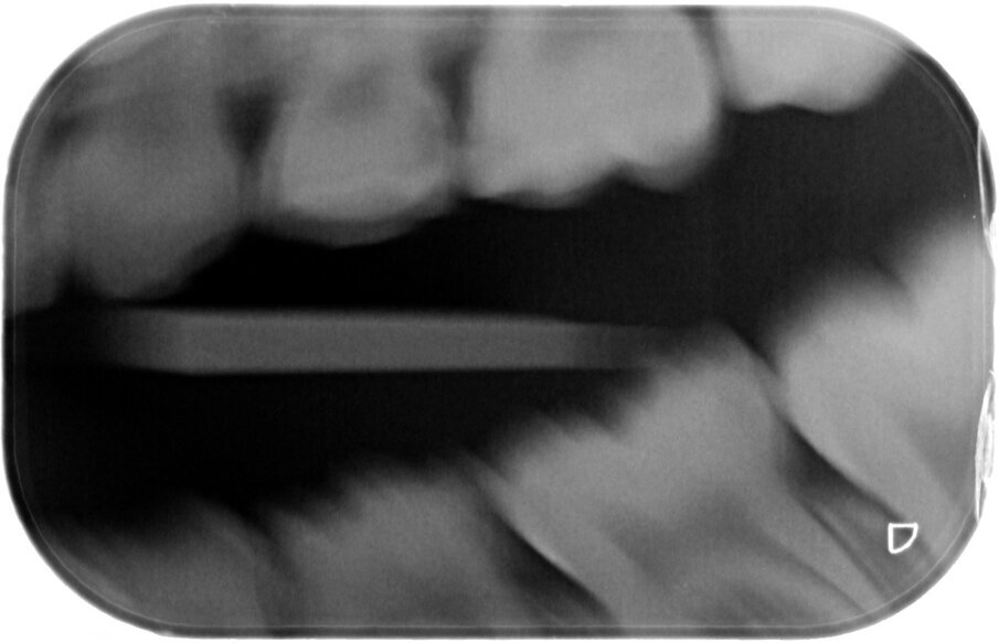 Afbeelding 12a-b. Casus 4: 21-02-18. BWR en BWL. Angstig meisje met pijn bij eten en poetsen bij 84 en 74.