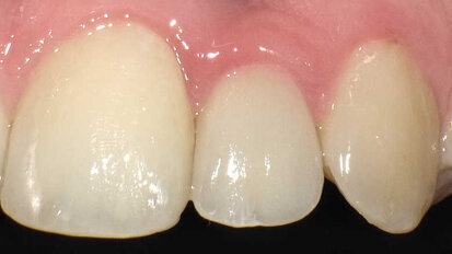 Ouverture de l’espace inter-radiculaire pour la pose d’un implant étroit