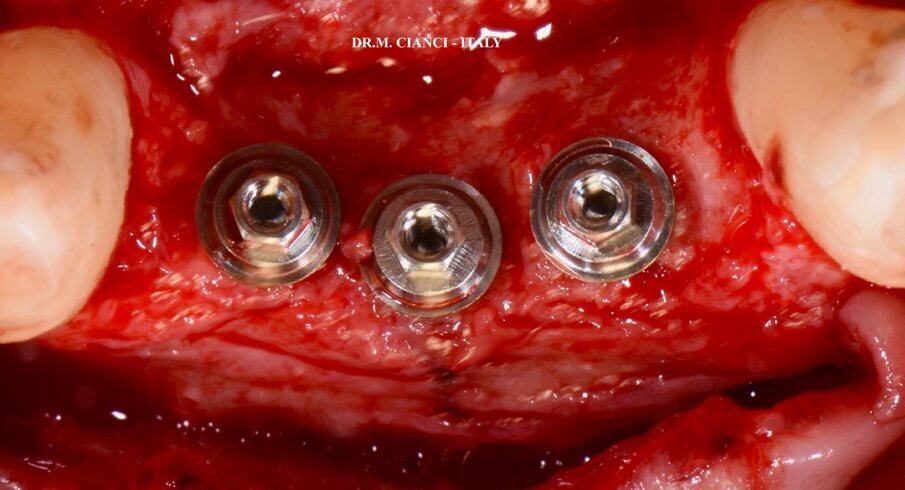 Fig. 11 - Abutments Transepiteliali MULTI-IM (visione occlusale).