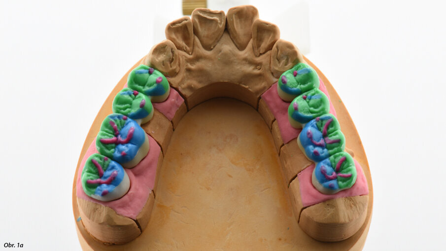 Technika wax-upu od zubního technika Dietera Schulze