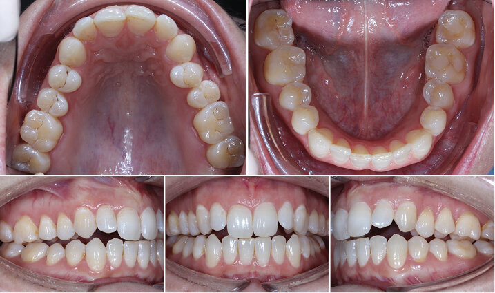 Vstupní intraorální fotografie