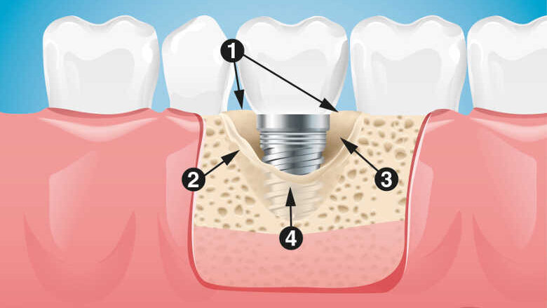 Proposition d’une nouvelle classification diagnostique et thérapeutique des péri-implantites