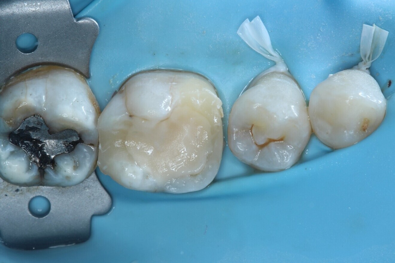 Fig. 8: Interim glass ionomer cement restoration placed to allow re-establishing of access to the canals at the next visit.
