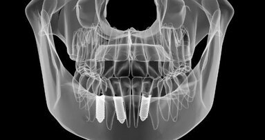 Onderzoek toont afwijking tussen geplande en feitelijke implantaatplaatsing