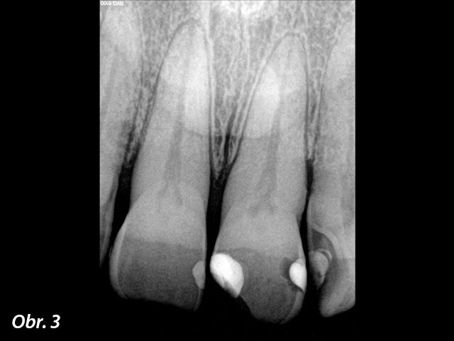 Výchozí RTG snímek.