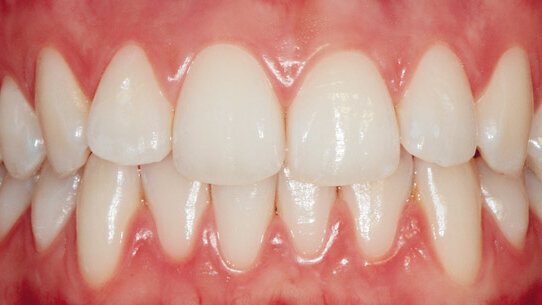 Riabilitazione estetica e funzionale dei settori posteriori con tecnica diretta e indiretta