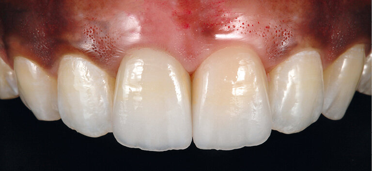 Fig. 18: The exceptional optical properties of IPS e.max CAD Impulse O1 enable a completely natural appearance …