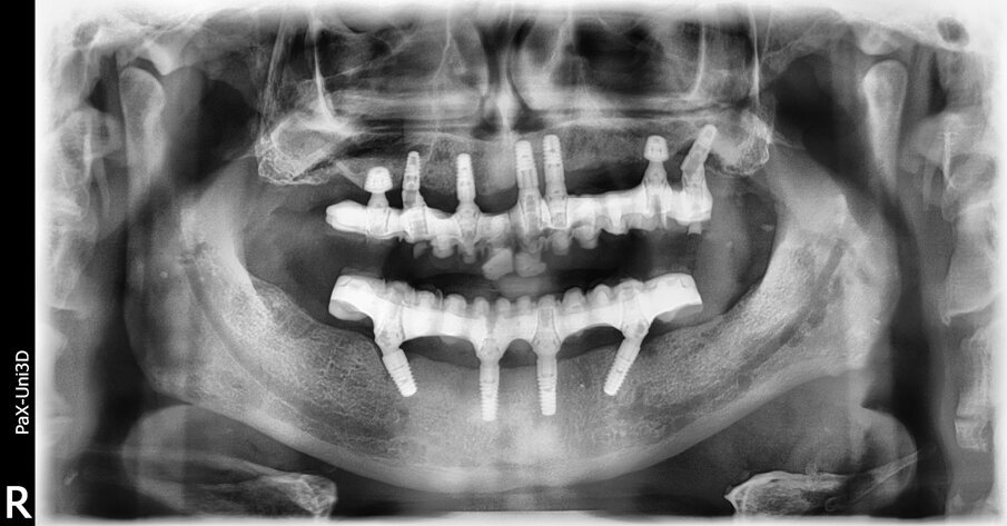 Fig. 11a_Ortopanoramica a 18 mesi. Appare evidente l’incremento della densità ossea intorno agli impianti, in particolare di quelli ultra-short.