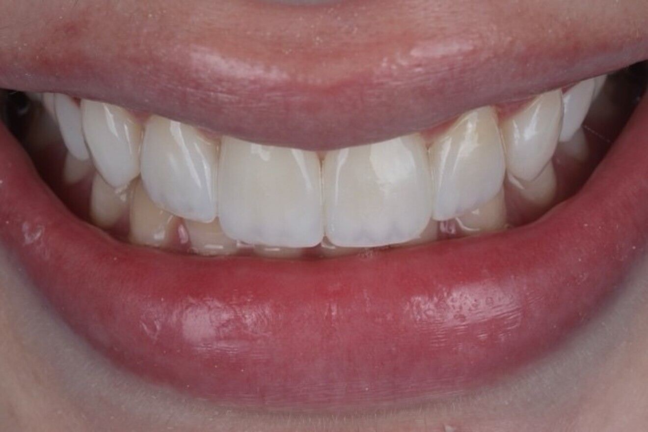 Fig. 2b: Patient smile after  smile modification.