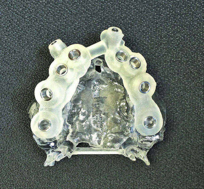 Fig 7 Guide chirurgical pour implants maxillaires