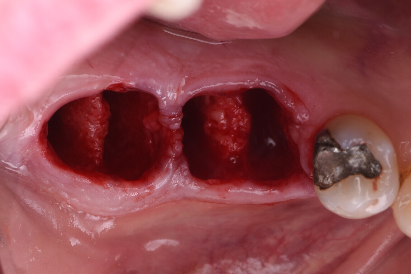 Fig. 9: Implants placed using a surgical guide to ensure precision. 
