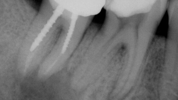 Imagerie 3D et endodontie : la supposition devient décision scientifique