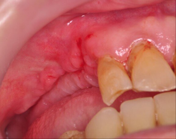 Ryc. 7_Stan 3 miesiące po zabiegu.