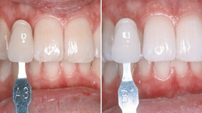 Online-Fortbildung thematisiert Erfolgsmodell Zahnaufhellung Online-Fortbildung thematisiert Erfolgsmodell Zahnaufhellung