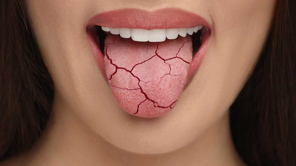 Neues Material zur Linderung bei Mundtrockenheit
