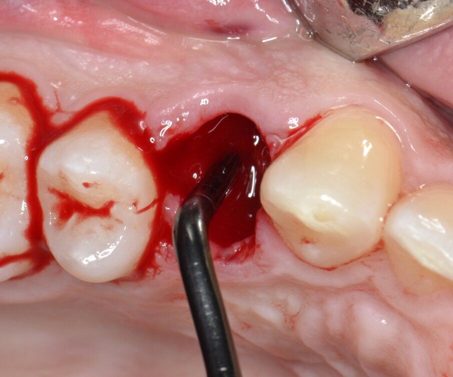 Fig. 9 - Preparazione iniziale del sito implantare con inserto ad ultrasuoni.