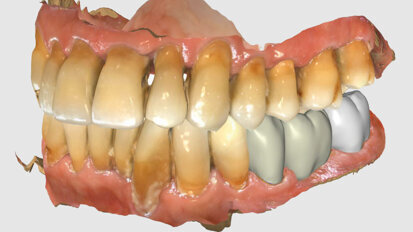 Fig. 4: Bridge design using CEREC Software.