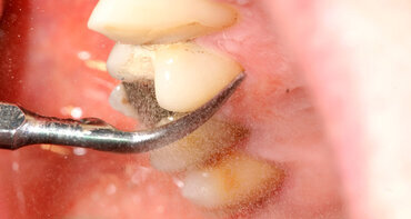 Nieuw bewijs verband parodontitis en diabetes