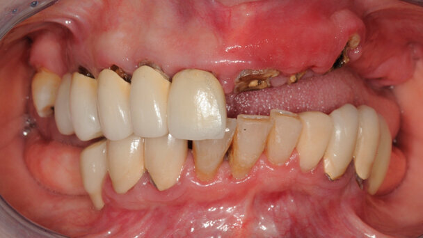 Oltre lo Smile Design. Cefalometria 3D per la  progettazione implanto-protesica