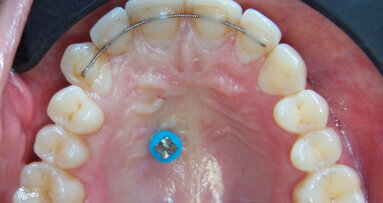 Composito Flow, filo intrecciato e microvite: quale novità?