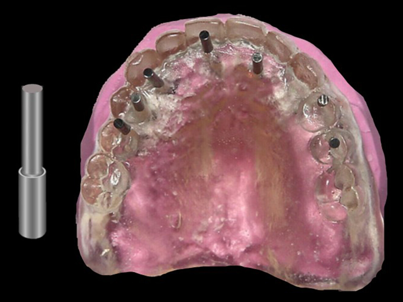 Fig. 10: Diagnostic guide on the putty base with 2 mm straight posts placed through the guided sleeves of the holes for implants in the sites of the maxillary right second premolar, right canine, left lateral incisor and left second premolar and for fixation screws in the sites of the maxillary right first premolar, right central incisor and left first premolar.
