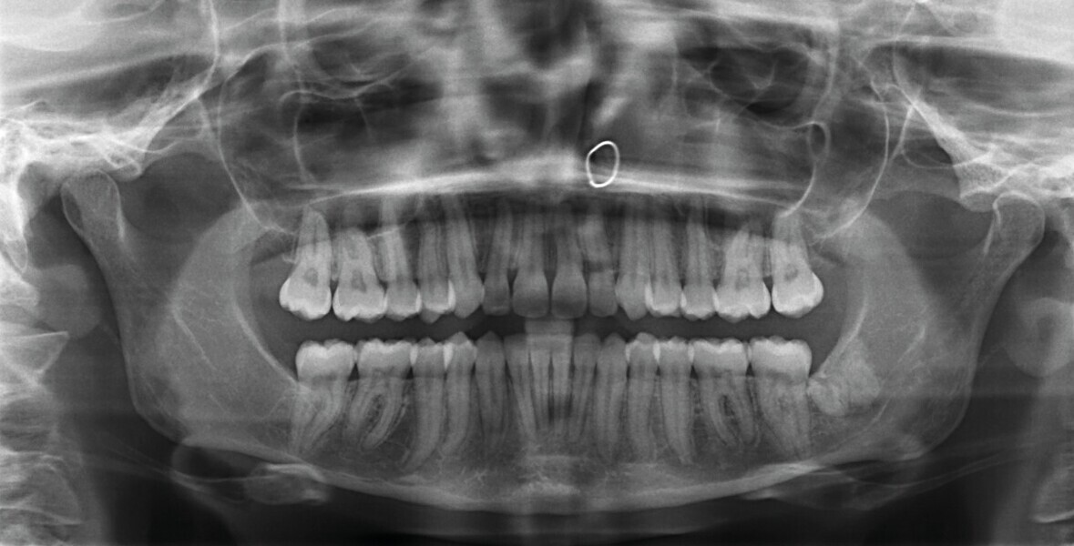 Fig. 7 : Radiographie panoramique finale. 