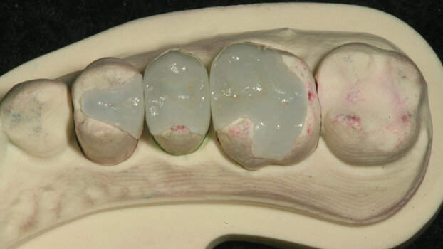 Digital impressions are reality with Cadent