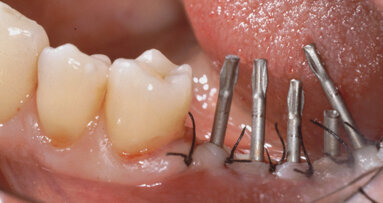 Welded titanium needle implants in treatment of bone atrophy