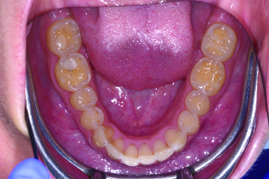 Fig. 1a_Caso iniziale: il paziente presenta perdita di dimensione verticale a causa di erosioni e abrasioni.