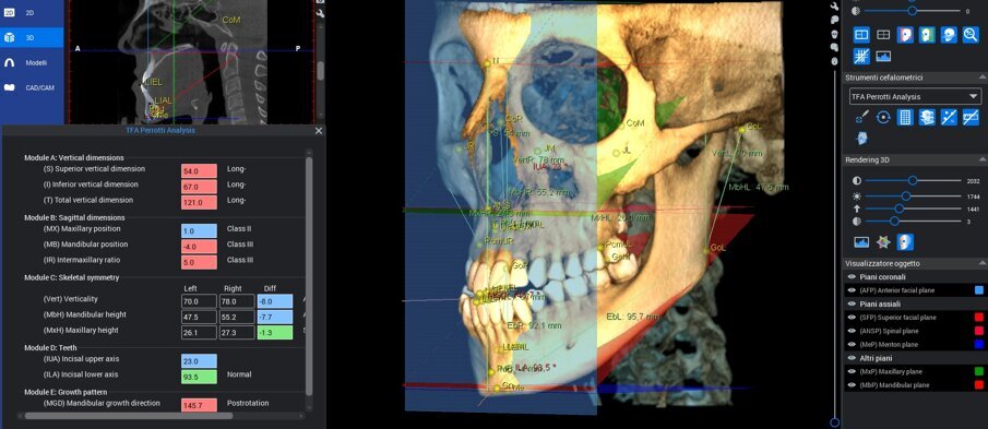 Fig. 1 - Cefalometria 3D multiplanare denominata Total Face Approach (TFA): valutazione di un caso prechirurgico.