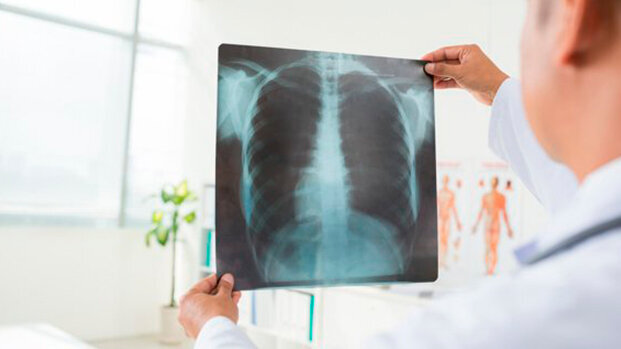 Il trattamento della carie può prevenire la polmonite nei pazienti affetti dal Parkinson