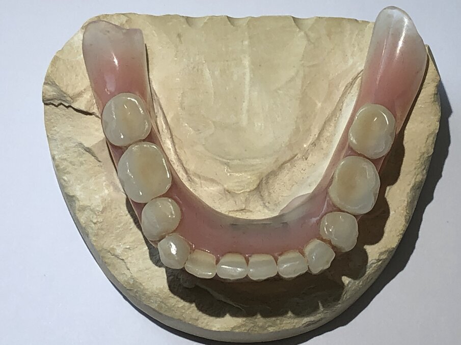 Afbeelding 1. Onderkaakprothese op staafconstructie.  