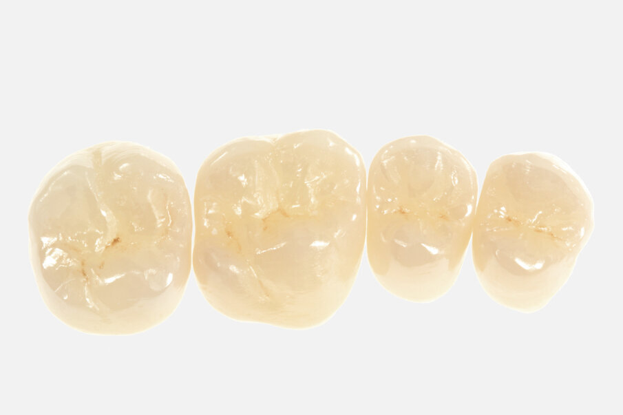 Fig. 19: The combination of areas with monolithic zirconia and areas with buccal veneering combines the entirely different advantages of two ceramics.