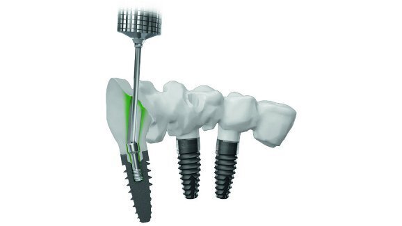 Heraeus Kulzer, Straumann och createch når överenskommelse