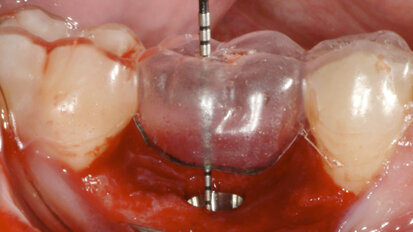 Achieving anatomical shape, support and colour with an Atlantis patient-specific abutment