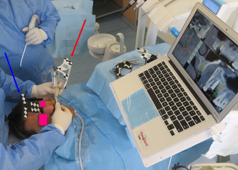 Fig. 9 - Spiegazione del principio di funzionamento della chirurgia navigata con protocollo Trace And Place. La posizione della Tac viene matchata alla posizione reale del paziente mediante l’head tracker (freccia blu) riconosciuto dal sistema e la procedura di trace registration già vista. L’head tracker è solidale al paziente e dunque i movimenti del paziente comportano un movimento nello spazio dei dati TAC. La posizione della punta dello strumento lavorante viene letta attraverso il drill tag sempre riconosciuto dal sistema; per consentire di conoscere la posizione della punta dello strumento rispetto al drill tag è necessaria una manovra di calibrazione (Fig.10).