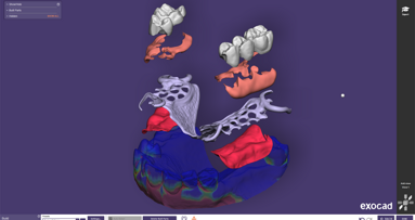Exocad introduces PartialCAD 3.2 Elefsina for greater design flexibility for partial dentures