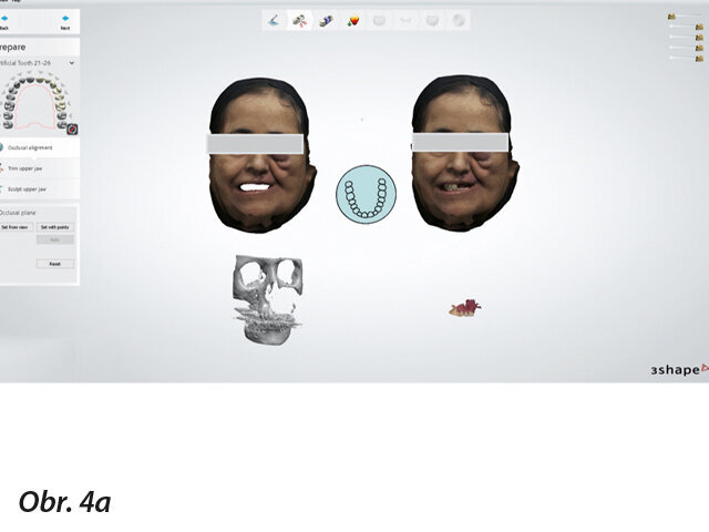 Získaná 3D data umístěná do jednoho softwaru: data ze skenu obličeje, CBCT a intraorálního skenování.