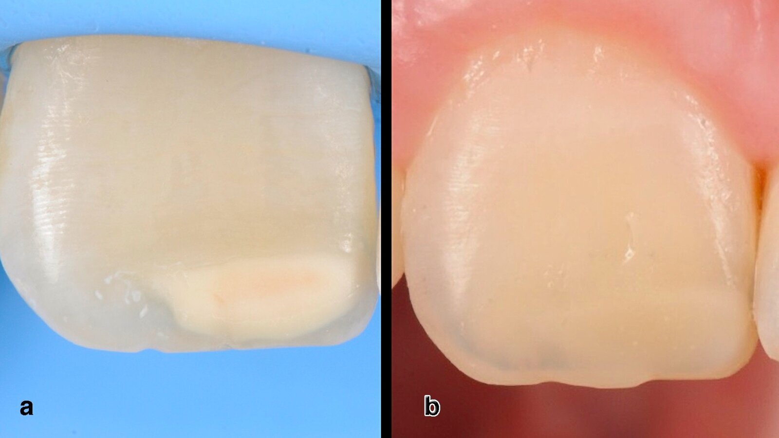 Infiltración de diente hipomineralizado reconstruido con resina compuesta