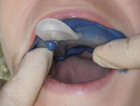 Fig. 11: The 3M™ Directed Flow Impression Tray has been loaded and is seated intraorally. Note the extrusion of impression material in the area of the impression coping.