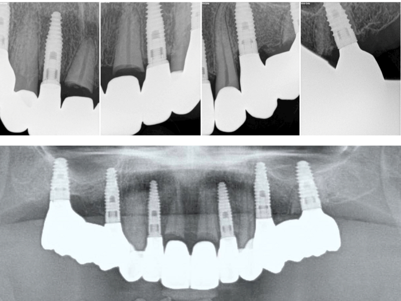 Fig. 21: Radiographic control after the two-year follow-up period, showing no visible bone loss at the implant sites and no signs of periapical inflammation at submerged roots.